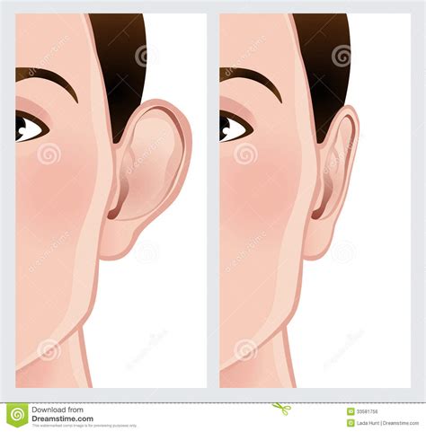 Ear Pinning Otoplasty Stock Illustration Illustration Of Pinning