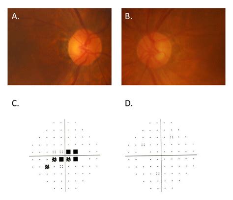 Ab Color Fundus Photographs Of The Right Eye A And Left Eye B 1