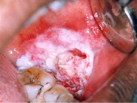 A Digital Manual For The Early Diagnosis Of Oral Neoplasia