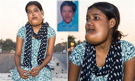 Indian Girls Cheeks Swell Due To Mysterious Condition