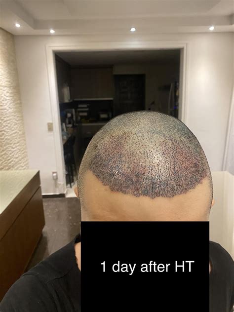 1 Month After Hair Transplant Currently On The Ugly Duck Phase R