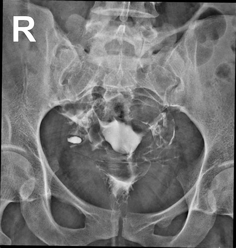 Right Tubal Isthmus Diverticulum Hysterosalpingogram Image