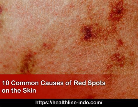 10 Common Causes Of Red Spots On The Skin Healthline Indonesia