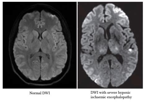 Radiological Findings In Hypoxic Ischaemic Encephalopathy Deranged