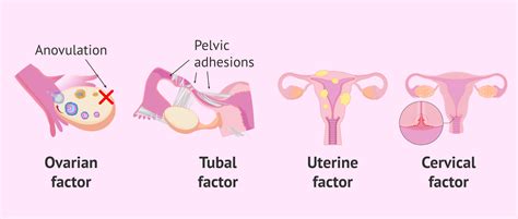 Causes Of Female Infertility