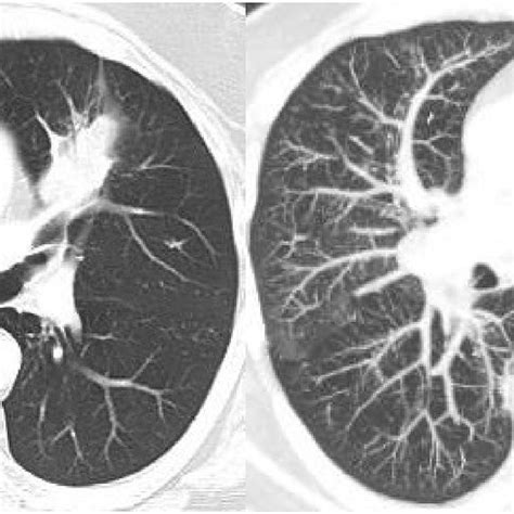 Computed Tomography Of Chest Showing Left Lung Mass Left And
