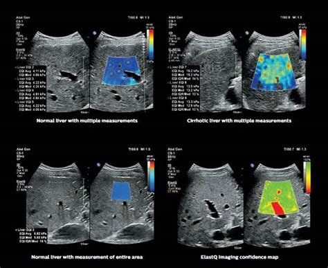 Elastography A Non Invasive Approach To Measuring Liver Damage
