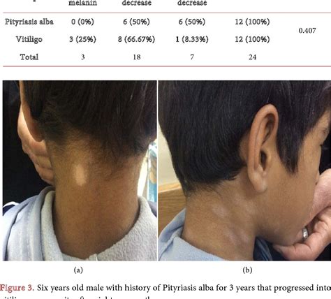 Figure 3 From Pityriasis Alba Versus Vitiligo Clinical And