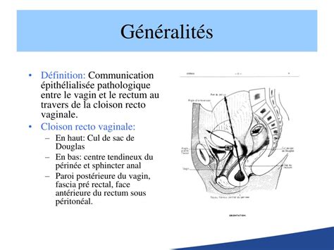 PPT Fistules Recto Vaginales PowerPoint Presentation Free Download ID