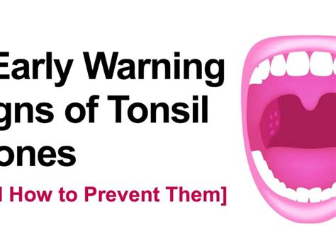 The Best Tools For Removing Tonsil Stones