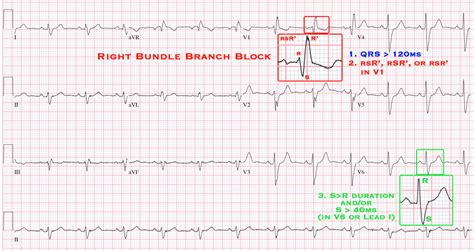 Bundle Branch Blocks Cardio Guide
