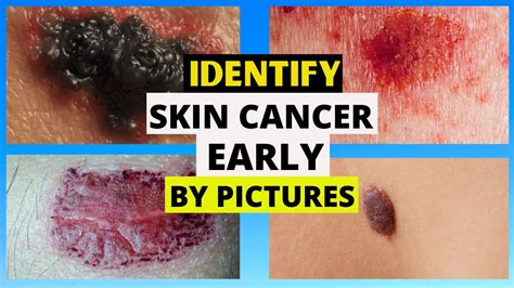 Skin Cancer Pictures Early Stages Types Melanoma Abcde Criteria