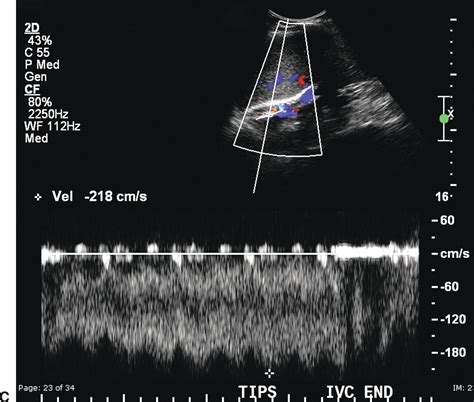 Ultrasound Evaluation Of The Portal And Hepatic Veins Thoracic Key