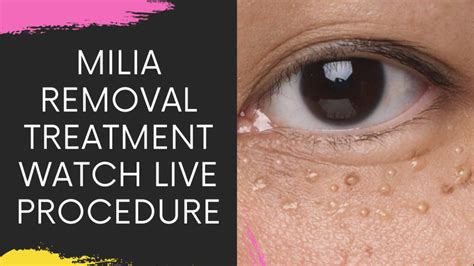 Milia Removal Treatments In Navi Mumbai Milia Eyelid Milia