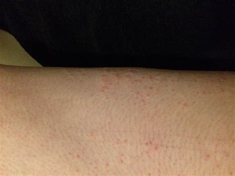 How To Prevent Rash After Shaving Legs Rmtf