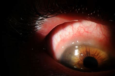 Moran Core Conjunctivitis