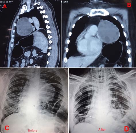 Scielo Brasil Primary Mediastinal Hydatid Cyst Causing