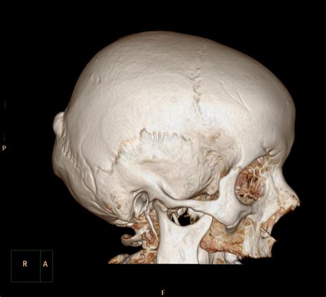 Skull Osteoma Image