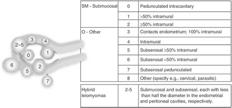Uterine Fibroid Subclassification Within The Figo Abnormal Uterine