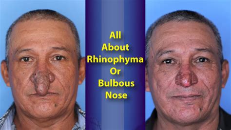 New York Man Treated For Rhinophyma Or Bulbous Nose Causes Symptoms