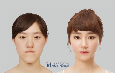 Id Hospital Korea Plastic Surgery Id Hospital Korea Our Patients Top