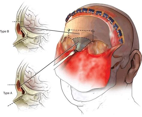 Anterior Craniofacial Resection Raveh Technique Ento Key