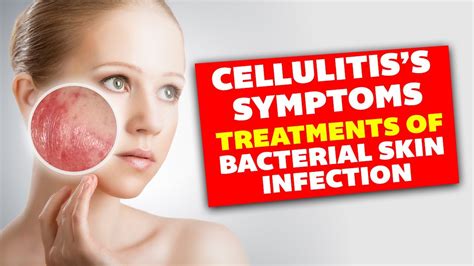 🔥cellulitiss Symptoms Causes Treatments Of Bacterial Skin