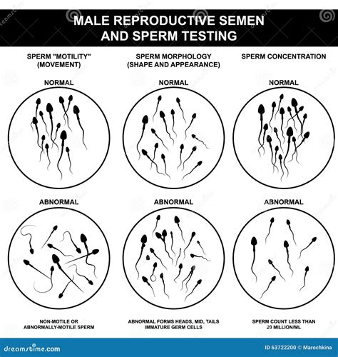Sperma normale ed anormale illustrazione di stock. Illustrazione di