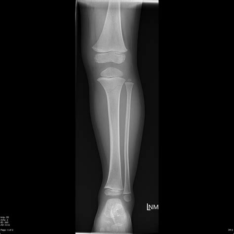 Proximal Tibial Fracture Image