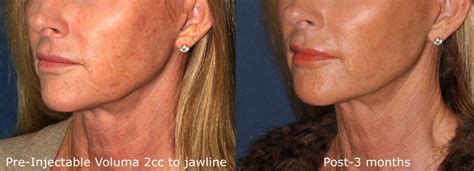 Juvederm Medical Spa San Diego Ca Cosmetic Laser Dermatology