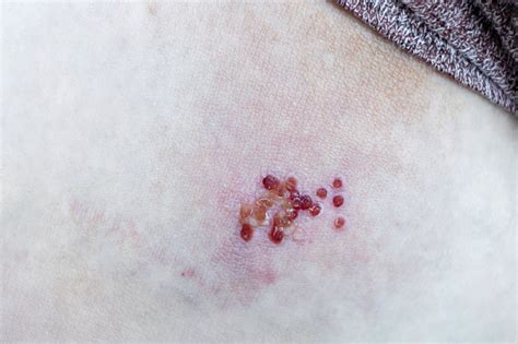 Woman With Shingles Or Herpes Zoster On Skin It Is Raised Red Bumps And