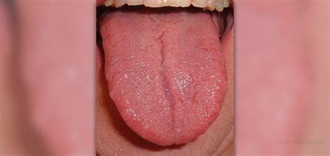 Red Spots On Tongue General Center