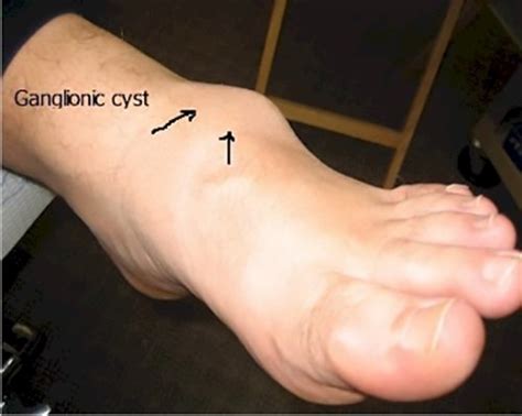 Ganglionic Cysts Of The Foot Causes And Treatment Options Myfootshop Com