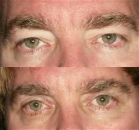 Blepharoplasty is a type of surgical procedure that repairs droopy eyelids. If The Condition Persists Beyond Two Or Three Months, An ...