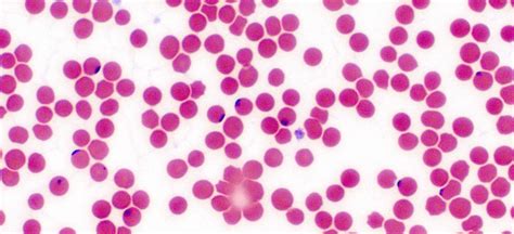 Lyme Sci Babesia And The Blood Supply