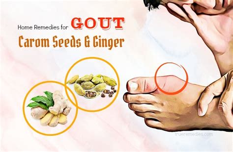 48 Home Remedies For Gout In Hands And Feet