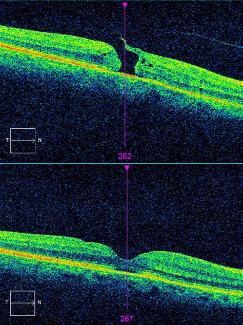 Macular Hole Repair Roptometry