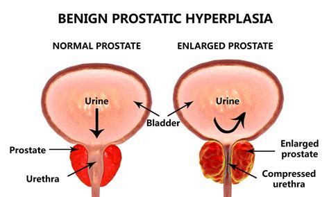 Non Surgical Treatment For Enlarged Prostate Bph