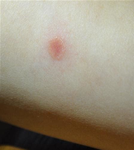 Has Anyone Here Ever Gotten Ringworm Photo Of The Biterash