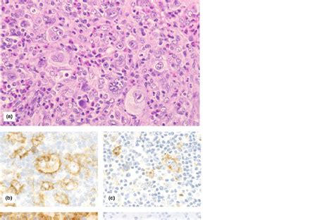 Histological Findings Of Classical Hodgkin Lymphoma Type Download