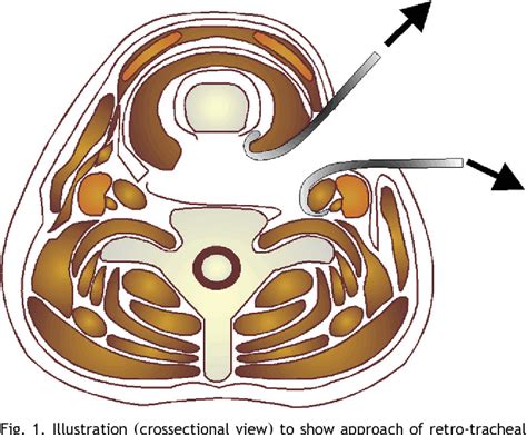 Figure 1 From A Novel Surgical Technique Of Repair Of Posterior Wall