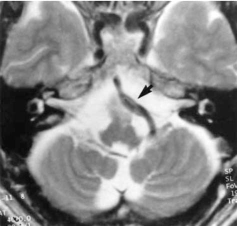 Figure 1 From Medullary Pyramidal Infarction Caused By Vertebral Artery