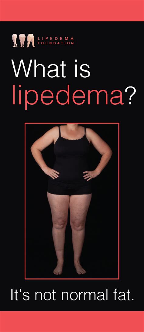 Lipedema Foundation