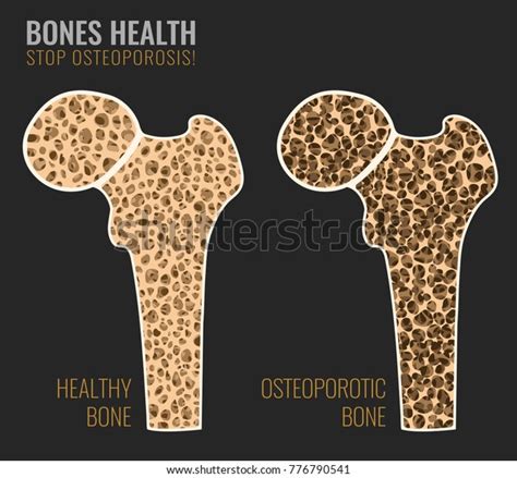 Bird bone cross illustrations & vectors. Osteoporosis Cross Section Image Osteoporosis Bone Stock ...