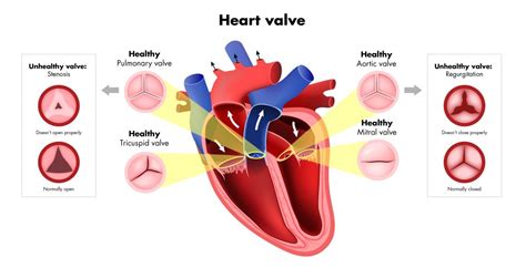 Heart Valve Disease Hearts 4 Heart