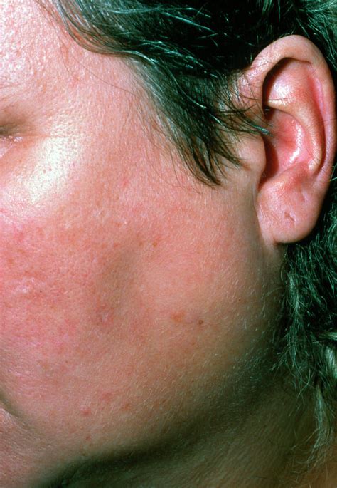 Parotid Swelling Due To Blocked Salivary Duct Photograph By Science