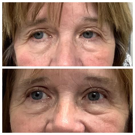 Blepharoplasty Before And After Joseph Eye And Laser