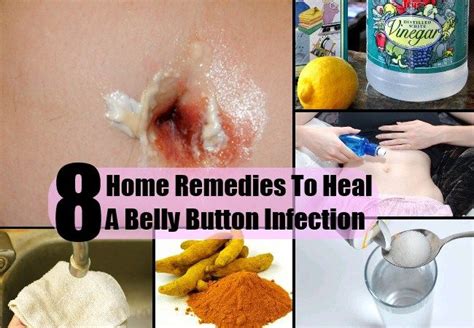 8 Top Home Remedies To Heal A Belly Button Infection Infected Belly