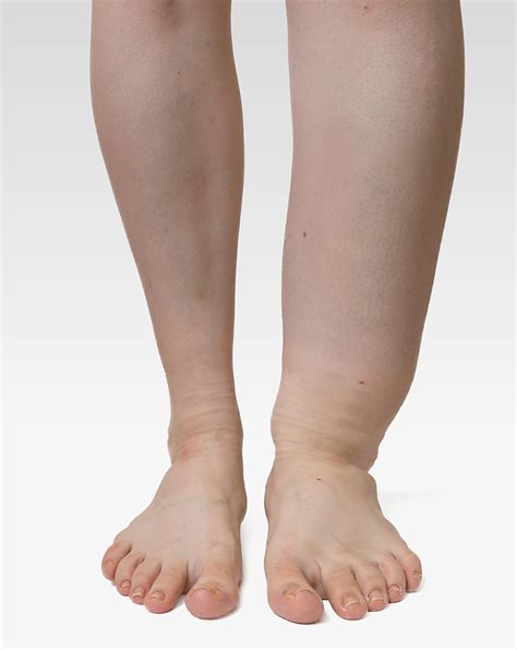 Leg Swelling And Lymphedema The Institute For Vein Health Peter
