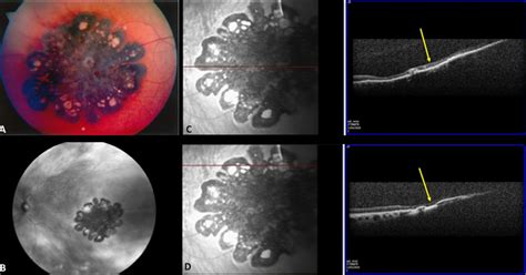 Congenital Hypertrophy Of Retinal Pigment Epithelium Bmj Case Reports